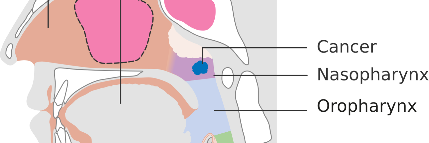 nasopharyngeal_cancer
